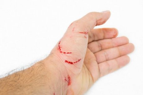 Etterspill av katteklorfeber