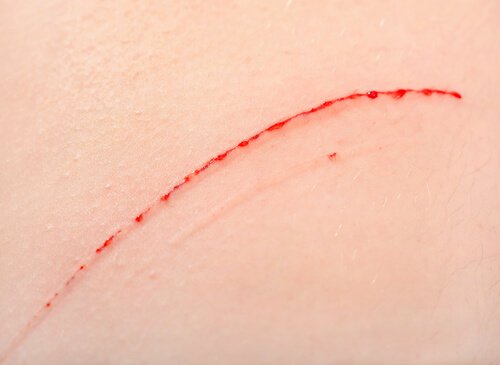 En katt klorte menneskets hud